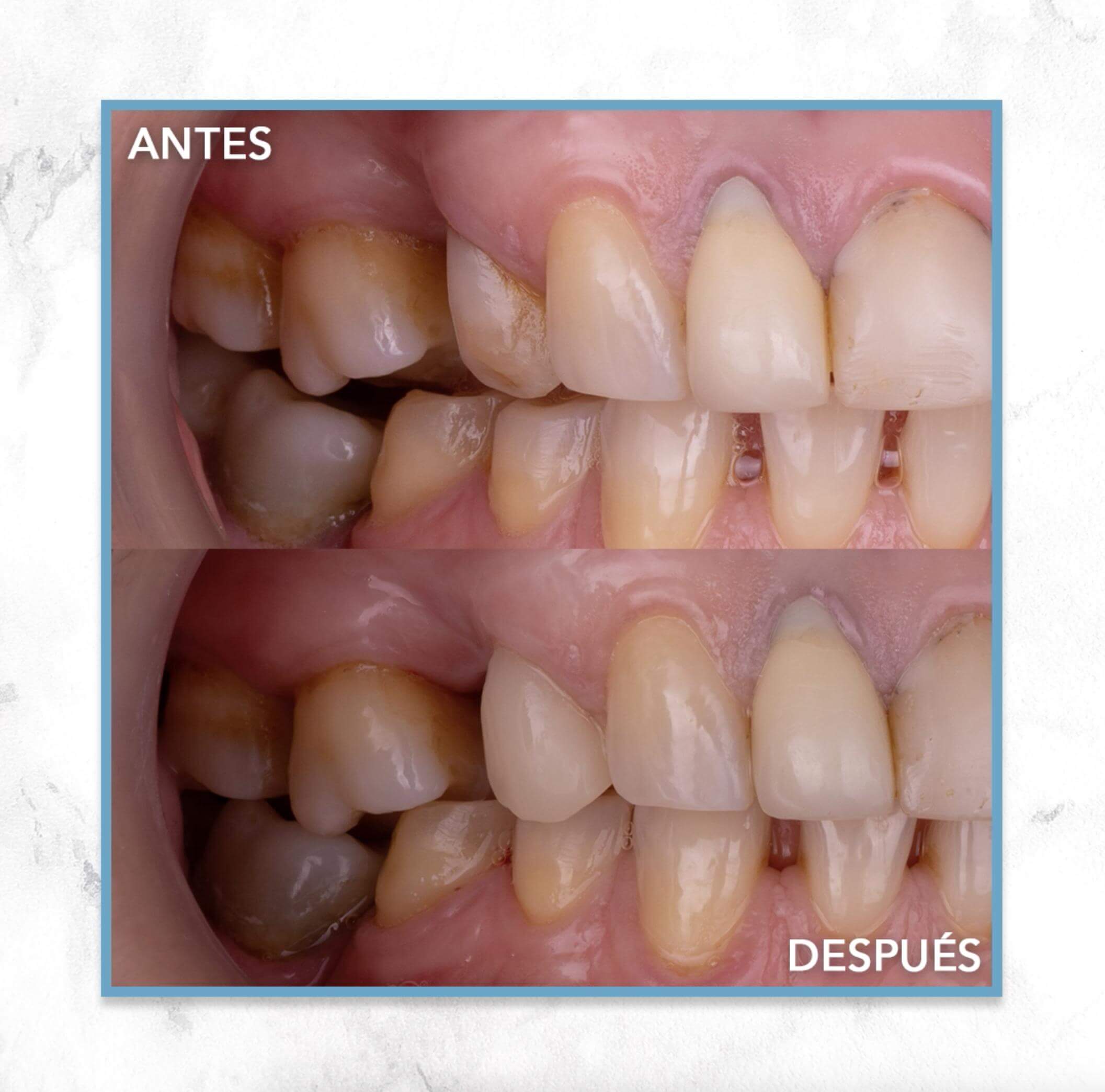 CAMBIANDO SONRISAS. RESINA CAD/CAM UNA SOLUCIÓN ESTÉTICA Y ECONÓMICA